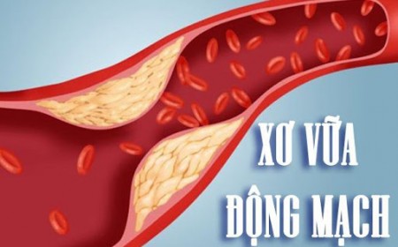 ĐỘT QUỴ CÓ THỂ XẢY RA BẤT CỨ LÚC NÀO KHI BỊ XƠ VỮA  MẠCH MÁU