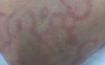 Vì Sao Ngứa Dạng Vòng Kéo Dài Không Khỏi? Bác Sĩ Giải Đáp