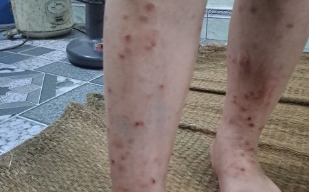 Vì Sao Trẻ Dễ Nhiễm Giun Sán Vào Mùa Hè?