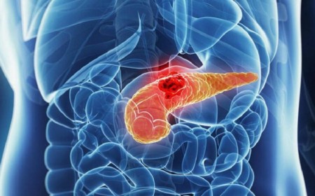 NHẬN BIẾT NGUYÊN NHÂN VÀ ĐIỀU TRỊ VIÊM TỤY CẤP 