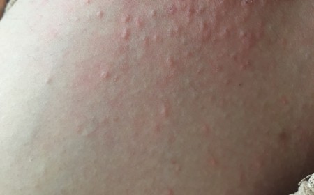 Xét Nghiệm Toxocara Kết Quả 0,5 Có Phải Nguyên Nhân Gây Mẩn Ngứa?