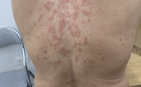 HÀ NỘI – NHIỄM BA LOẠI KÝ SINH TRÙNG DO THÓI QUEN ĂN MỘT MÓN ĂN SÁNG