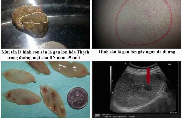 DẤU HIỆU NHẬN BIẾT BỆNH SÁN LÁ GAN LỚN