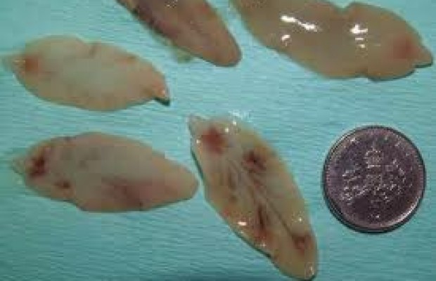 Điều trị bệnh sán lá gan ở đâu?