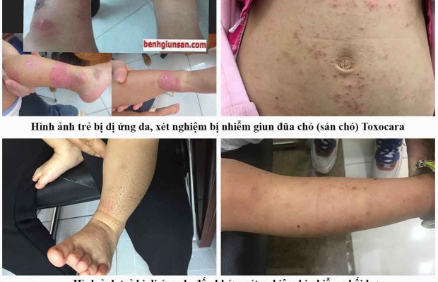 Khi Trẻ Bị Dị Ứng Da Cần Làm Xét Nghiệm Gì Tìm Nguyên Nhân Dị Ứng Da