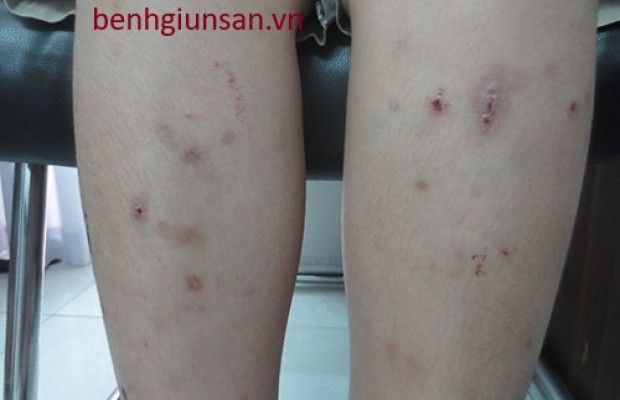 Mẩn Ngứa Da Nổi Mề Đay Có Phải Do Nhiễm Giun Sán Không?