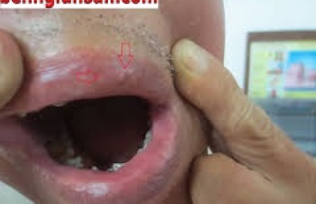 Mẩn Ngứa Da Nổi Mề Đay Có Phải Do Nhiễm Giun Sán?
