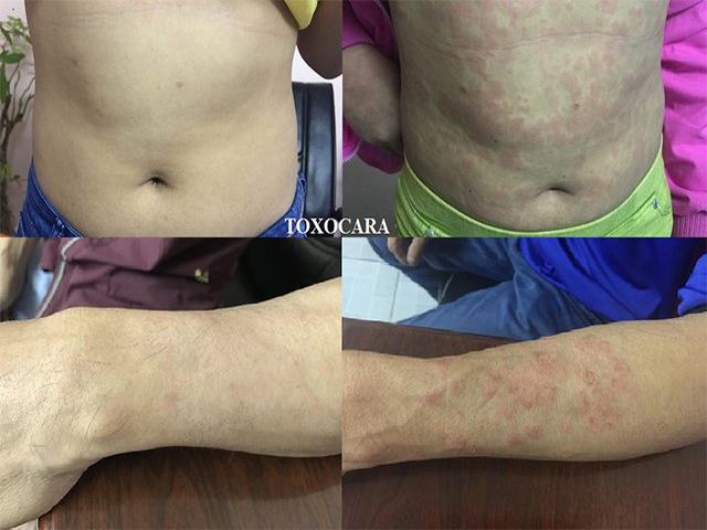 Bị Ngứa Da Nổi Mề Đay Kéo Dài Có Phải Do Nhiễm Bệnh Giun Sán?