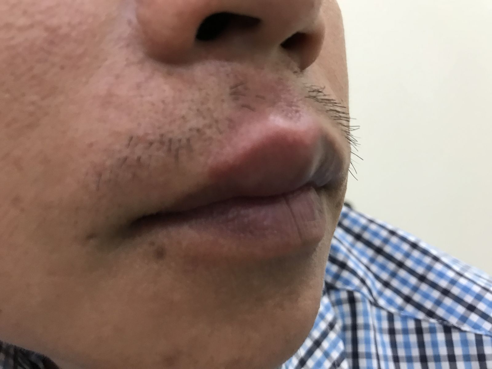 Bị Ngứa Da Nổi Mề Đay Kéo Dài Có Phải Do Nhiễm Bệnh Giun Sán?