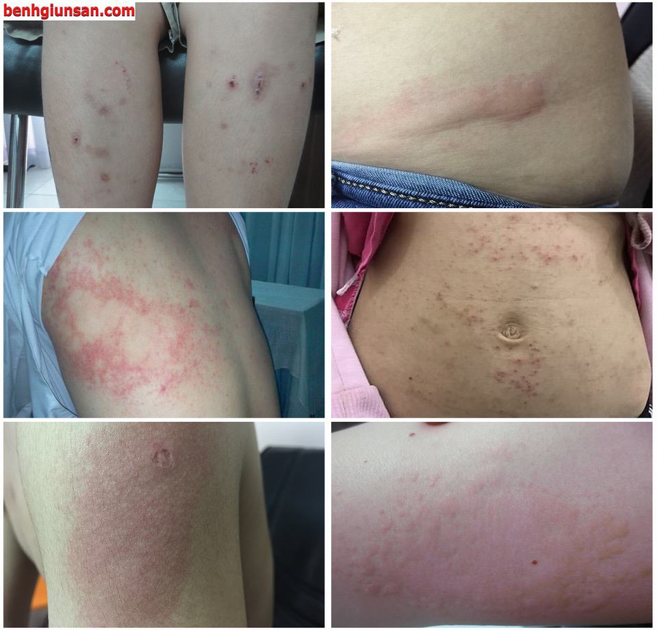 Bệnh Chàm Và Những Yếu Tố Liên Quan Đến Bệnh Giun Sán
