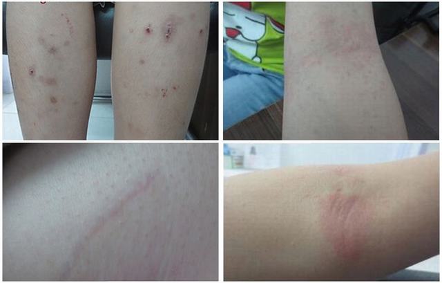 Bệnh sán chó những điều cần biết về bệnh sán chó