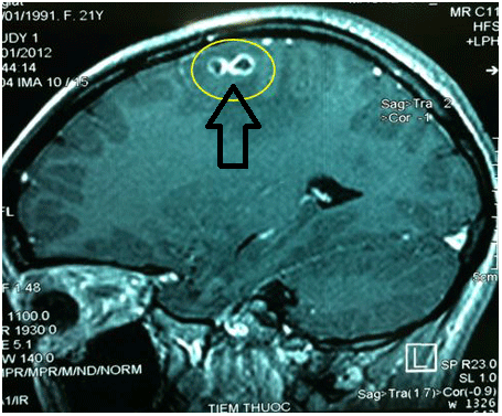 Bệnh sán chó những điều cần biết về bệnh sán chó