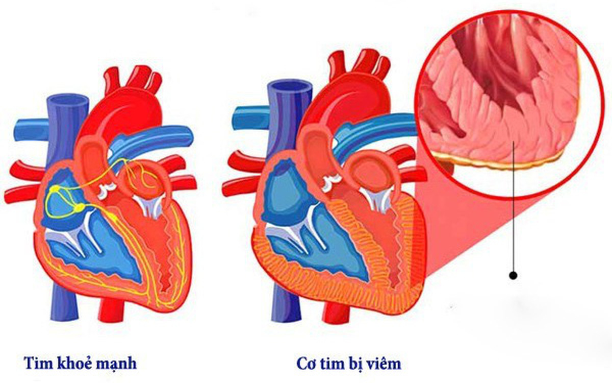 Viêm cơ tim ở trẻ em