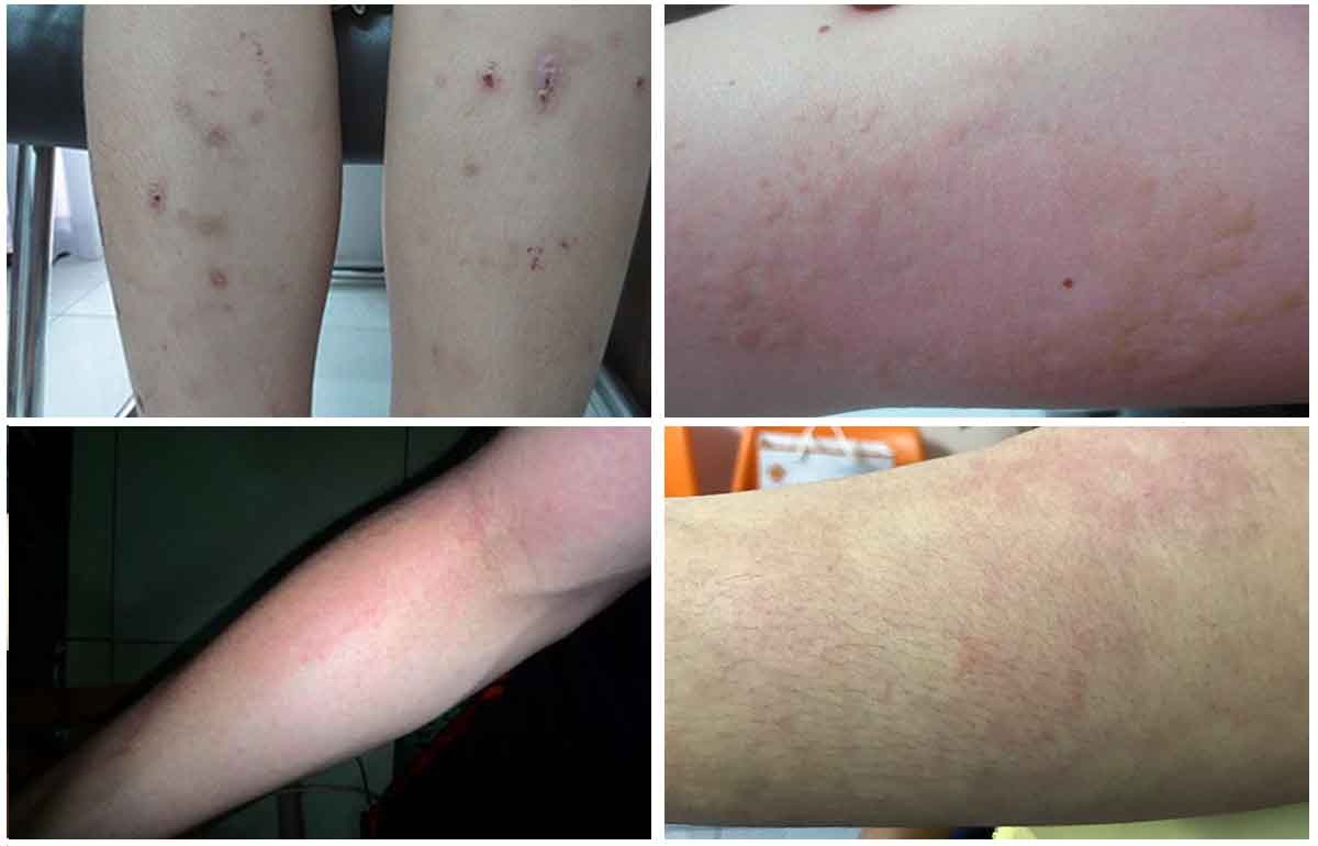 Dị Ứng Ngứa Chàm Dị Ứng Gây Ngứa Da Do Nhiễm Giun Sán 