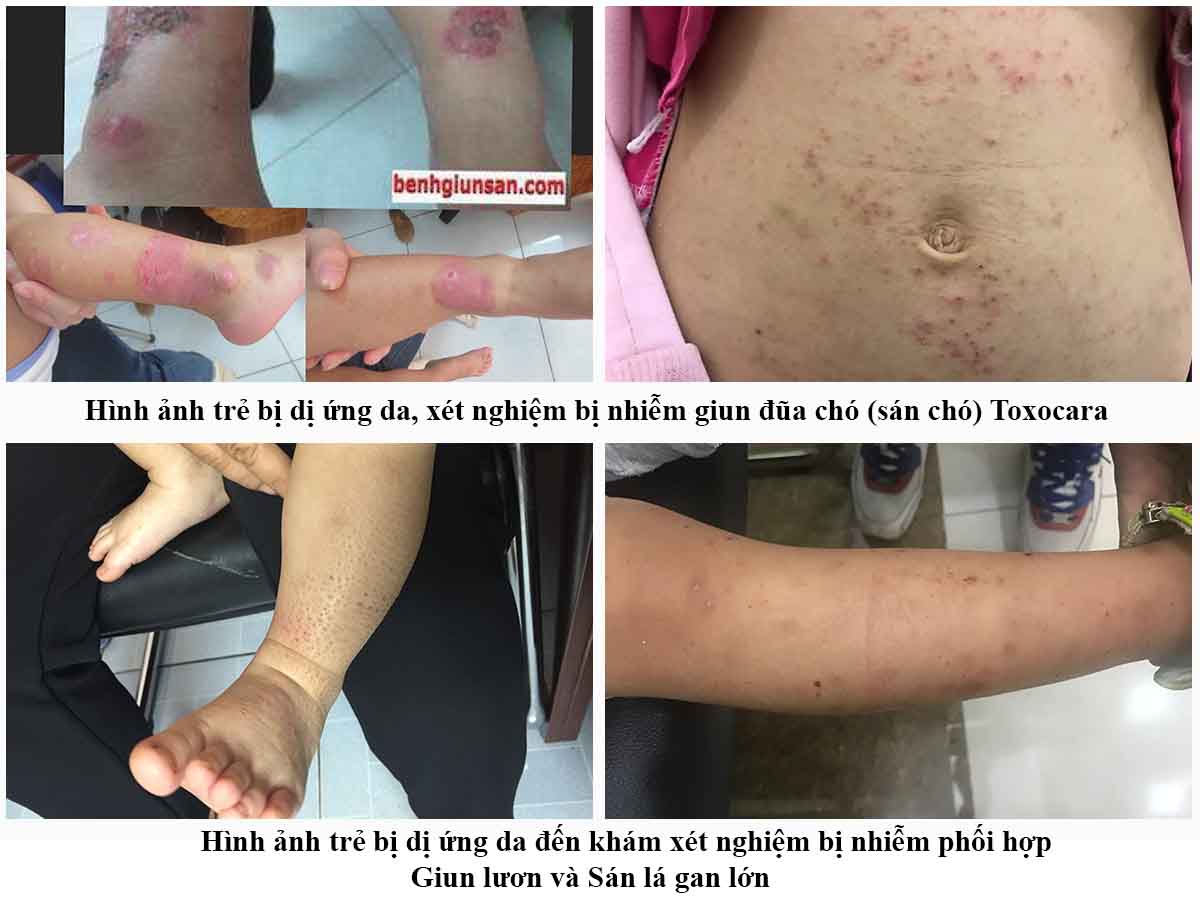 Khi Trẻ Bị Dị Ứng Da Cần Làm Xét Nghiệm Gì Tìm Nguyên Nhân