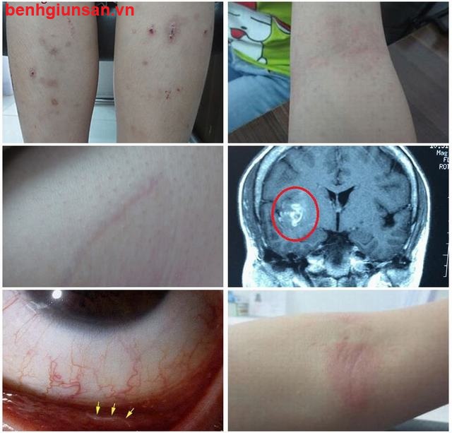 Mẩn Ngứa Da Nổi Mề Đay Có Phải Do Nhiễm Giun Sán Không?