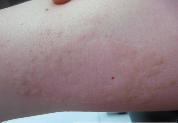 Mẩn Ngứa Da Nổi Mề Đay Có Phải Do Nhiễm Giun Sán?