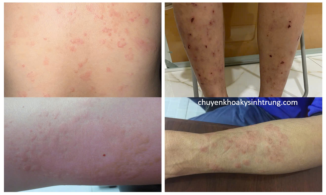 Ngứa Da Nổi Mề Đay Có Phải Do Nhiễm Giun Sán Không?