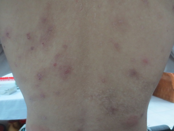 Ngứa Da Nổi Mề Đay Có Phải Do Nhiễm Giun Sán Không?