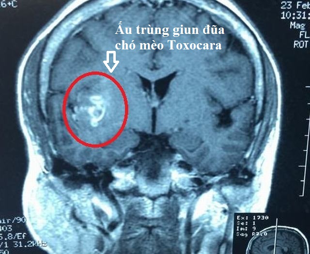 Ngứa Da Nổi Mề Đay Có Phải Do Nhiễm Giun Sán Không?