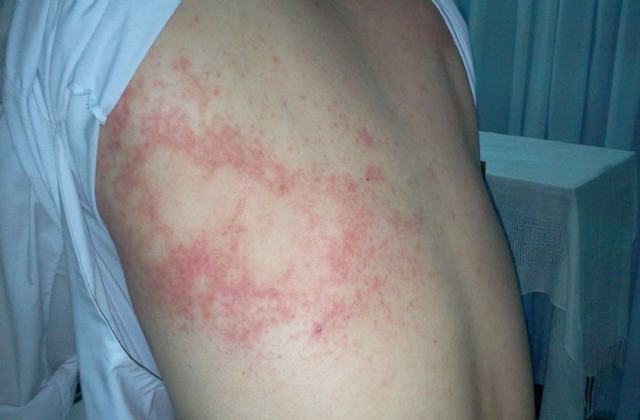 Ngứa Da Nổi Mề Đay Có Phải Do Nhiễm Giun Sán Không?