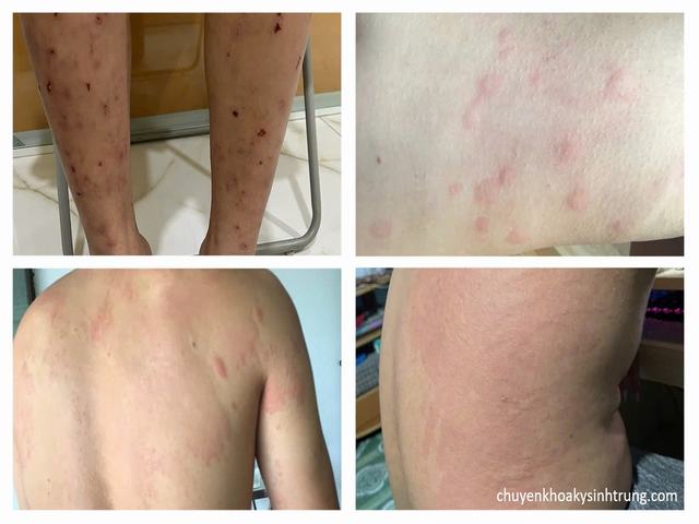 Thuốc Điều Trị Bệnh Sán Chó, Bệnh Sán Chó Bao Lâu Xét Nghiệm Lại?