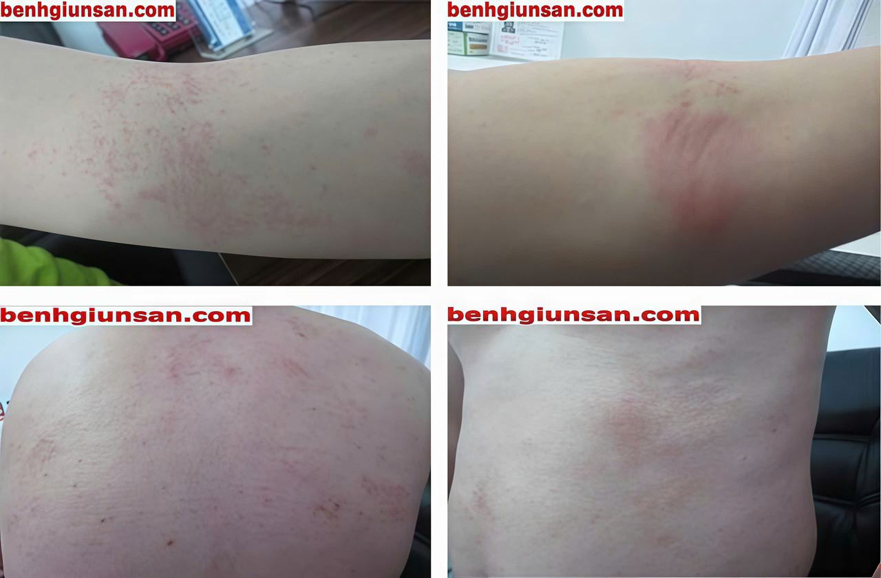 TRIỆU CHỨNG GIUN SÁN CHÓ MÈO