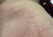 Bệnh Sán Dây Chó Echinococcus: Nguyên Nhân, Chẩn Đoán Và Cách Điều Trị