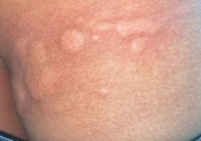 Bệnh Nhân Hỏi – Bác Sĩ Tư Vấn: Ấu Trùng Giun Sán Có Gây Ngứa Mề Đay Không?