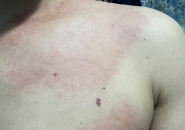 Bệnh Sán Chó Mèo Toxocara: Nguyên Nhân, Triệu Chứng Và Điều Trị