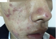 Cách Trị Dị Ứng Da Lâu Ngày Hiệu Quả Tại Phòng Khám Ký Sinh Trùng