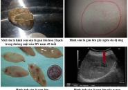 DẤU HIỆU NHẬN BIẾT BỆNH SÁN LÁ GAN LỚN