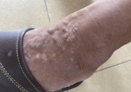 Nổi Cục Dị Ứng Mẩn Ngứa Kéo Dài Có Phải Do Sán Chó Mèo?
