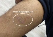 Bệnh Giun Móc Ancylostoma: Nguyên Nhân Lây Nhiễm, Triệu Chứng Và Cách Điều Trị Hiệu Quả