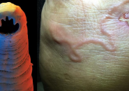 Giun Móc Và Giun Mỏ: Hiểu Đúng Để Phòng Bệnh Hiệu Quả