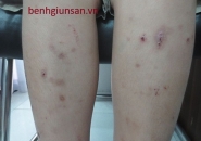 Mẩn Ngứa Da Nổi Mề Đay Có Phải Do Nhiễm Giun Sán Không?