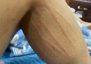 Mẩn Ngứa Kéo Dài Có Phải Do Ấu Trùng Giun Sán Chó Mèo?