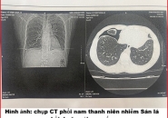 Bệnh Sán Lá Phổi: Nguyên Nhân Lây Nhiễm Và Cách Điều Trị Hiệu Quả