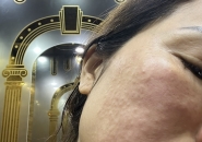 Ngứa Da Mặt Kéo Dài Có Phải Do Demodex?