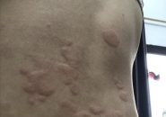 Ngứa Da, Nổi Mề Đay Dai Dẳng: Có Liên Quan Ấu Trùng Giun Sán?