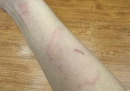 Ngứa Da Nổi Vòng Loang Rộng Cảnh Báo Nhiễm Giun Sán Toxocara