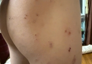 Ngứa Da Ở Trẻ Kéo Dài Tái Phát: Cảnh Báo Nhiễm Ấu Trùng Giun Đũa Chó Mèo