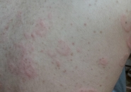 Nhiễm Bệnh Sán Chó Mèo Toxocara Vì Thói Quen Ăn Uống