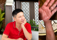 NSƯT Chí Trung Nhiễm Sán Chó Toxocara Sau Nhiều Tháng Ngứa Kéo Dài