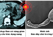 Sán Dây Chó Echinococcus: Nguyên Nhân, Điều Trị Và Phòng Ngừa