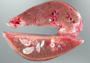 Sán Lá Gan Lớn: Nguyên Nhân Lây Nhiễm, Triệu Chứng Và Cách Điều Trị Hiệu Quả