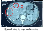 Sán Lá Gan: Phân Biệt Sán Lá Gan Nhỏ Và Lớn, Con Đường Lây Nhiễm