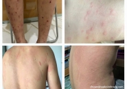 Thuốc Điều Trị Bệnh Sán Chó, Bệnh Sán Chó Bao Lâu Xét Nghiệm Lại?