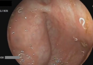 Trẻ Ngứa Hậu Môn Ban Đêm Có Phải Giun Kim?