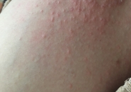Xét Nghiệm Toxocara Kết Quả 0,5 Có Phải Nguyên Nhân Gây Mẩn Ngứa?